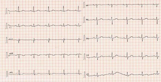 EKG-Kurve gesunder Herzrhytmus